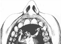 Sketch - Zahnarzt behandelt Zähne